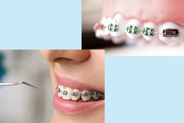 اجزای سیستم ارتودنسی