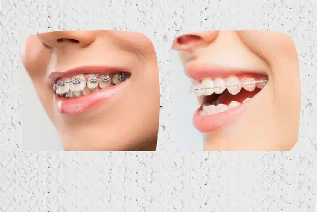 انواع روش های ارتودنسی